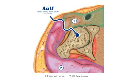 Abordagem anterior minimamente invasiva