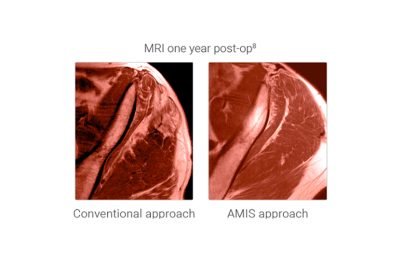 Abordagem anterior minimamente invasiva